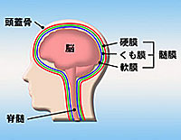 くも膜下出血