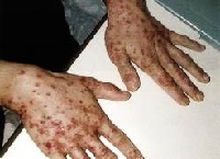 デング熱の症状