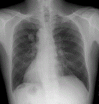 症状 肺がん 末期